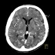 Metastasis in brain, multiple, multiple myeloma: CT - Computed tomography